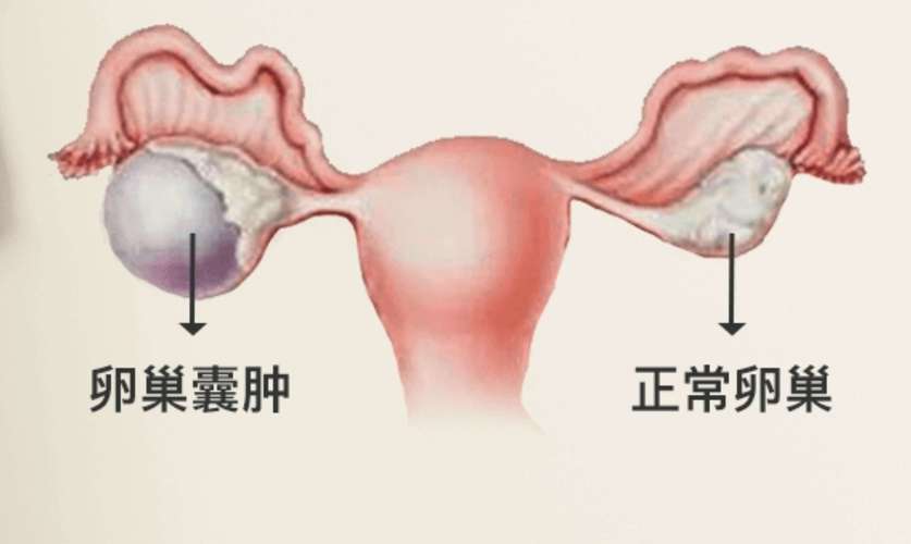 患有卵巢囊肿会对身体健康带来哪些影响？