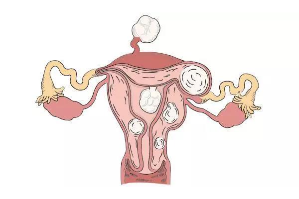 减肥后子宫肌瘤消失了是正常现象吗？需要去医院看吗？
