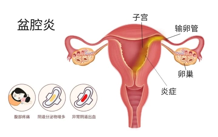 宫外孕是怎么回事？做试管婴儿会不会发生宫外孕？怎样预防宫外孕？