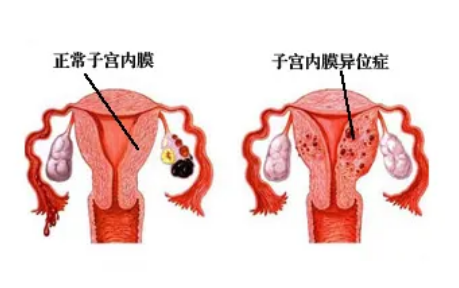 子宫内膜异位症对怀孕有什么影响？