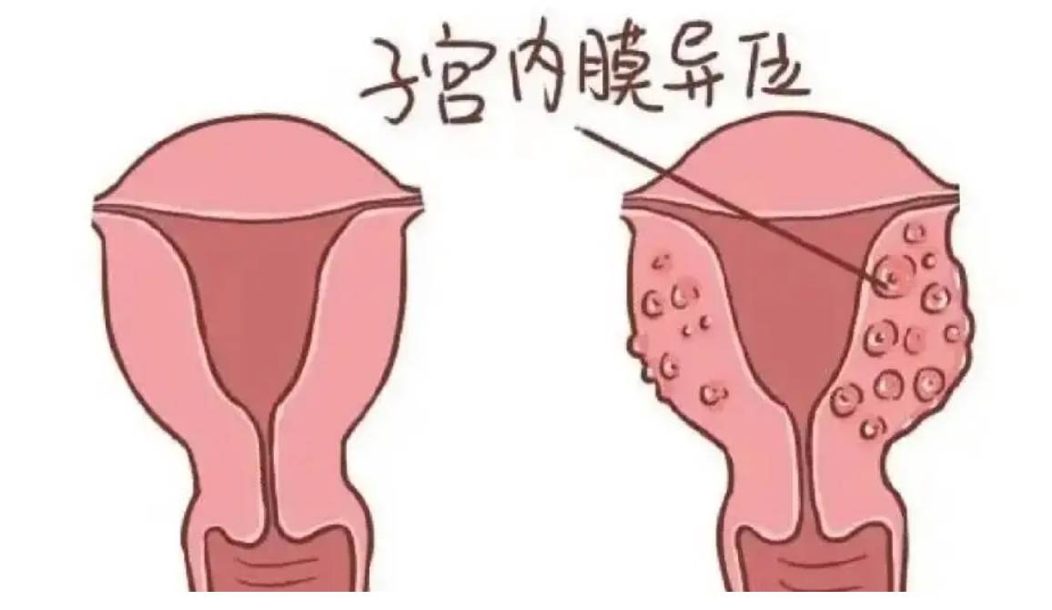 患有子宫内膜异位症想自然怀孕还能成功吗？