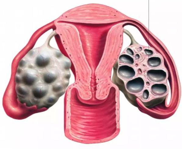 多囊卵巢综合症只能移植冻胚吗