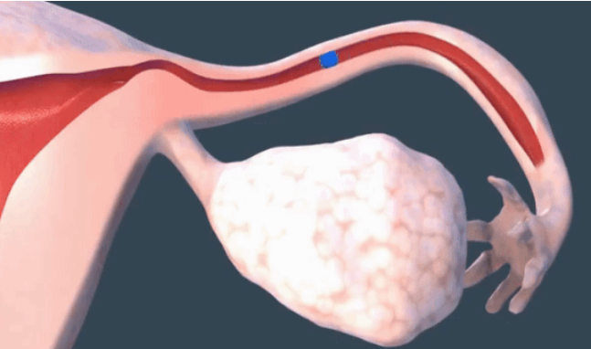 输卵管造影是什么？这些知识要知道