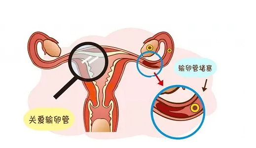 输卵管增粗也能做试管婴儿，不用担心不能怀孕