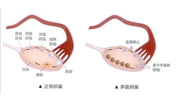 女性多囊做试管的优缺点解析