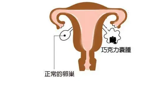 巧囊可以用中医疗法，针灸效果很不错