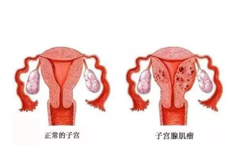 子宫腺肌症影响生育吗？