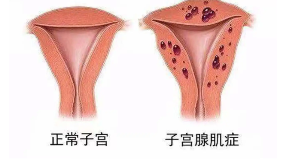 子宫腺肌症影响怀孕吗？